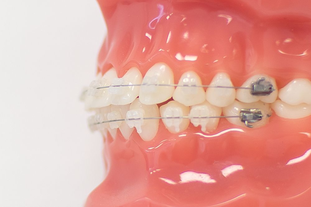 Braces for Malocclusion of Teeth